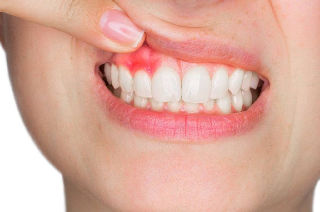 Cuidado Integral: Entendiendo y Previniendo Enfermedades Periodontales 