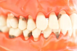 Combatiendo la Enfermedad de las Encías: Síntomas y Tratamientos