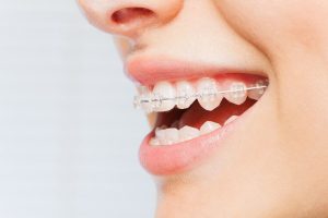 Innovaciones en Ortodoncia: Tendencias y Nuevas Técnicas. 