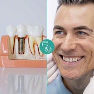 implantes dentales en merida extremadura